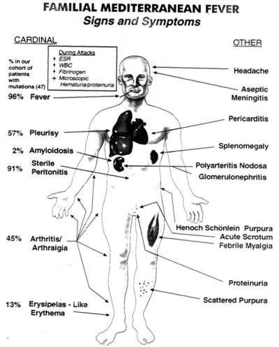 FMF Signs Symptoms Chart